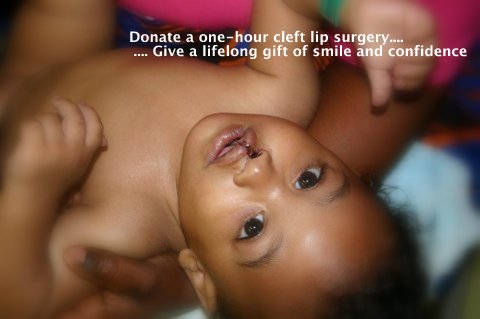 after photo cleft lip repair liberia