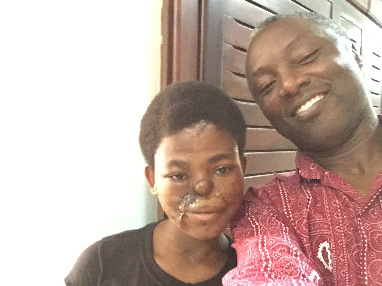 Here is an updated picture of Naomi with Dr. Boahene following our recent trip to Ghana. She underwent reconstruction of the lip. The next stage of surgery is reconstruction of her nose and forehead.